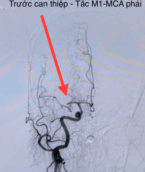   Hình ảnh đột quỵ não do tắc nghẽn mạch máu não - Ảnh BSCC
