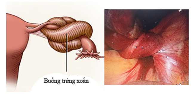  U buồng trứng là những khối xuất hiện bất thường ở vị trí buồng trứng