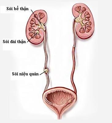   Các vị trí của sỏi niệu quản - Ảnh BSCC