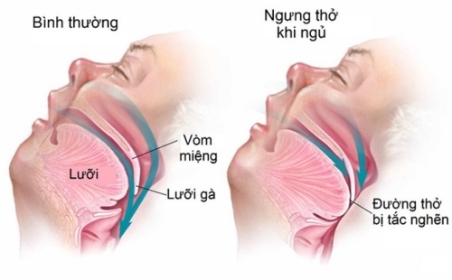  Đường thở ở người bình thường và người có hội chứng ngưng thở khi ngủ.