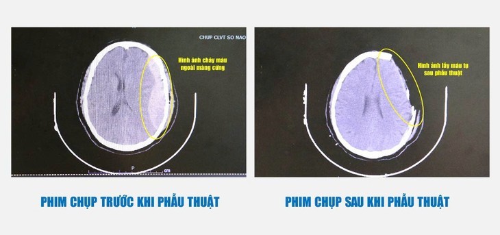   Hình ảnh phim chụp trước và sau khi phẫu thuật lấy máu tụ. Ảnh BVCC