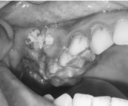  Gai đoạn sớm ung thư miệng có những triệu chứng gần giống với các bệnh lý răng miệng thông thường