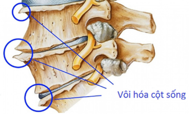  Hình ảnh vôi hóa cột sống.