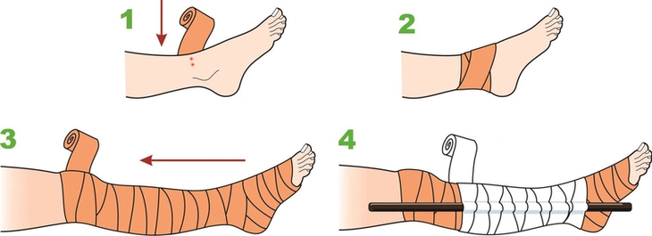  Cách băng cho bệnh nhân bị rắn cắn - Ảnh BSCC 