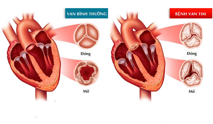  Bệnh van hai lá là bệnh khá phổ biến ở các nước đang phát triển, trong đó có Việt Nam.