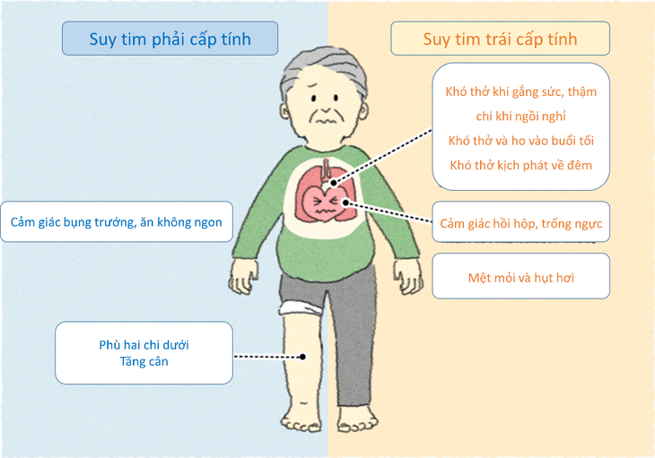   Các triệu chứng, dấu hiệu của suy tim cấp - Ảnh BSCC