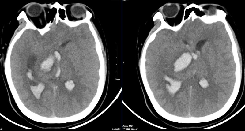  Hình ảnh chụp phim MSCT mạch não chảy máu não đồi thị - não thất do vỡ khối AVM (dị dạng thông động - tĩnh mạch não) bệnh nhân 15 tuổi. Ảnh BVCC