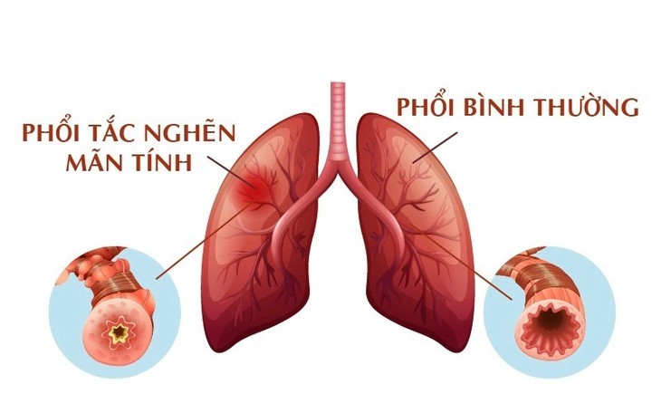  Cách chung sống hòa bình với bệnh phổi tắc nghẽn hơn 380 triệu người mắc - Ảnh minh họa BSCC 