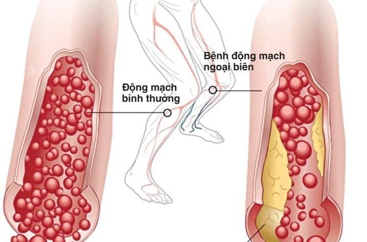   Xơ vữa, hẹp mạch gây thiếu máu mạn tính chi - Ảnh minh họa