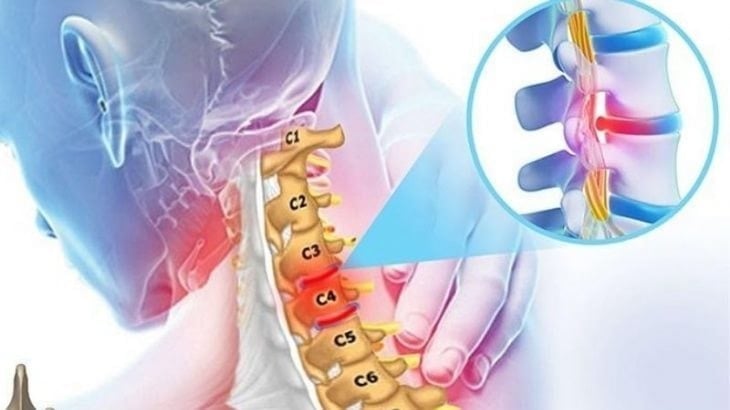 Thoái hóa đốt sống cổ C3 C4 đang ngày càng phổ biến ở dân văn phòng