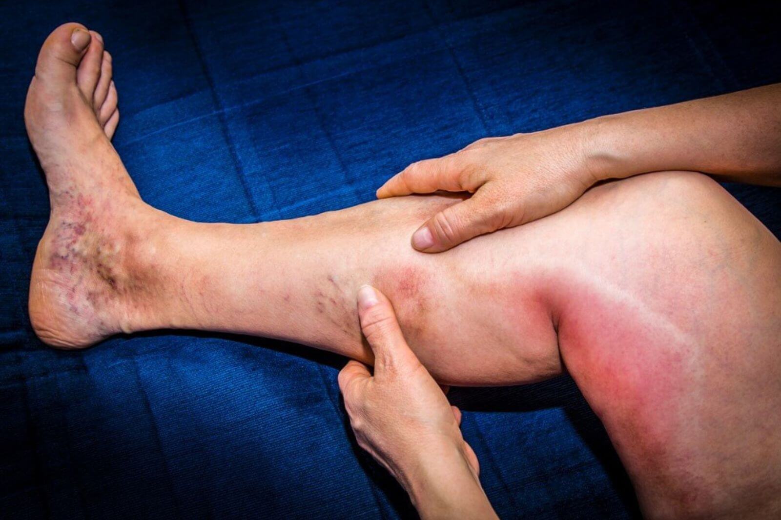 Hình ảnh huyết khối tĩnh mạch sâu ở chân (Ảnh: ST)
