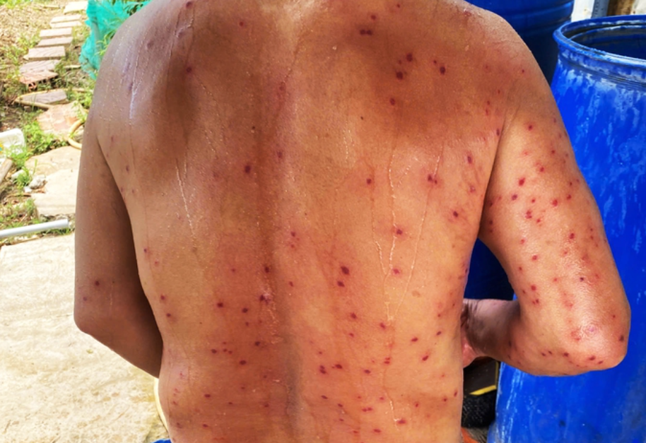 Vùng lưng ông D. bị ong vò vẽ đốt nhiều vết trong lúc đi câu cá - Ảnh: Báo Tuổi Trẻ