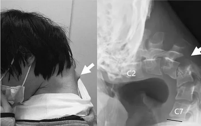 Chàng trai bị u sau gáy do cúi đầu chơi điện thoại quá nhiều (Ảnh odditycentral)