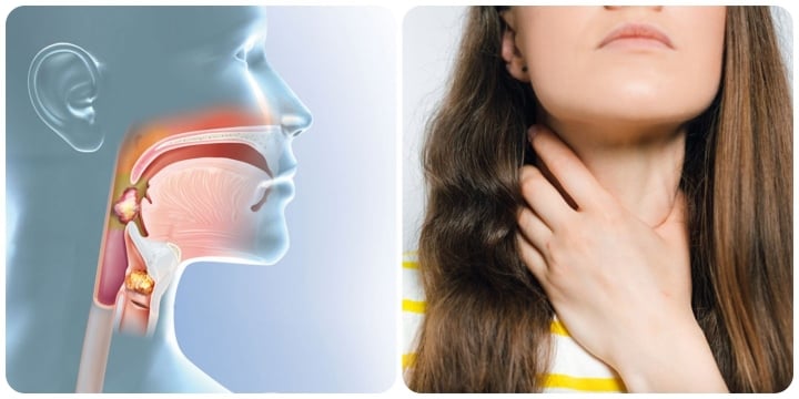 Nếu khối u phát triển xung quanh các dây thanh, sẽ dẫn đến việc thay đổi giọng nói.
