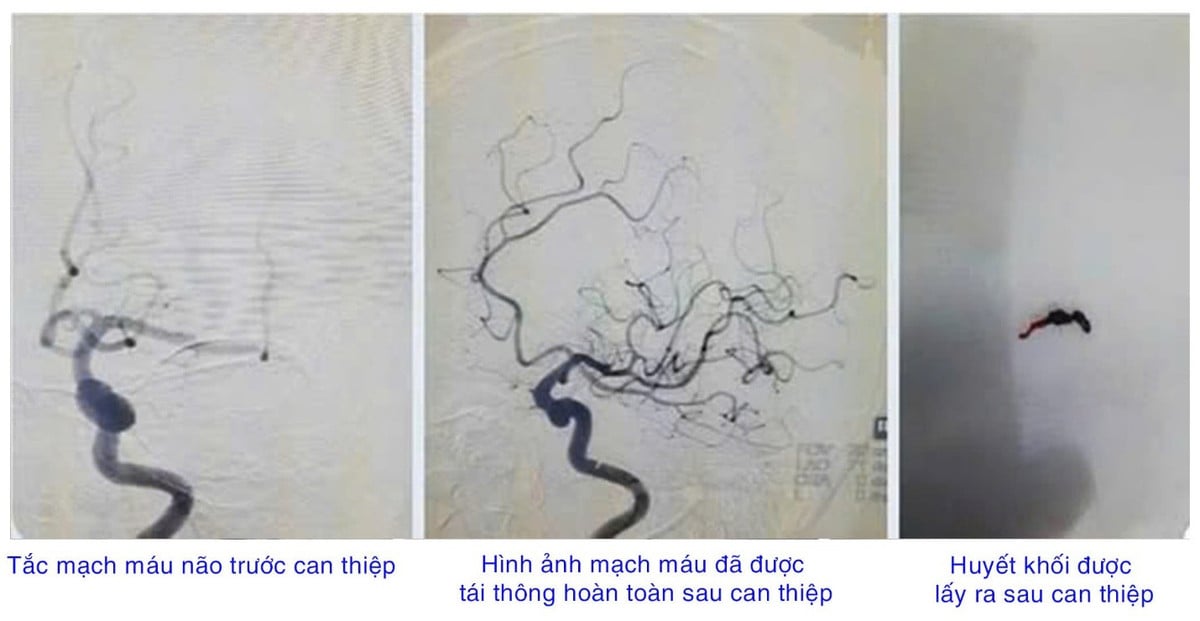 Hình ảnh phim chụp của cụ bà 92 tuổi - Ảnh bvcc