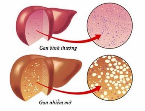 Biểu hiện của gan nhiễm mỡ - Ảnh minh họa