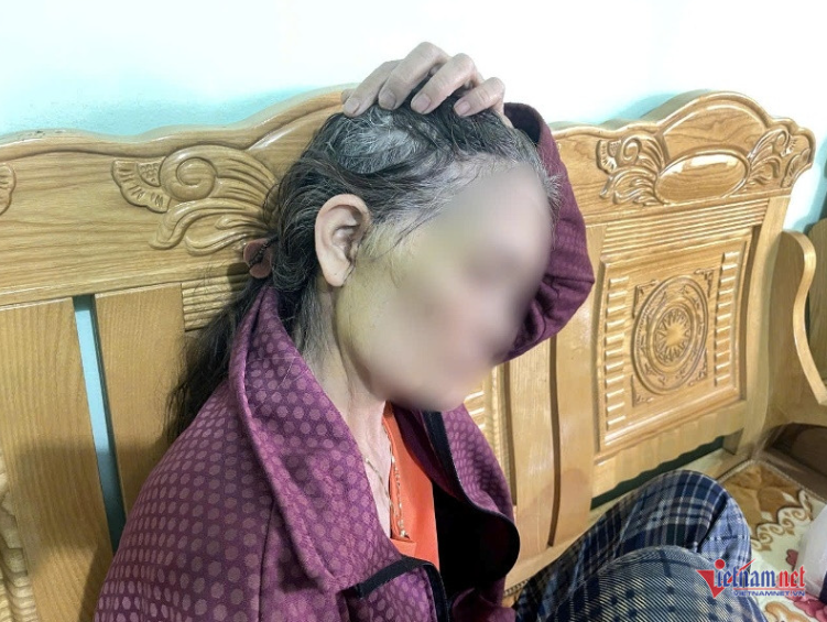 Sau phẫu thuật làm căng da mặt tại một cơ sở thẩm mỹ, bà L.T.H. bị biến chứng nghiêm trọng - Ảnh: VietNamNet