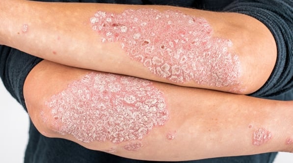 Vẩy nến với những tổn thương viêm đỏ, bong tróc vẩy trắng