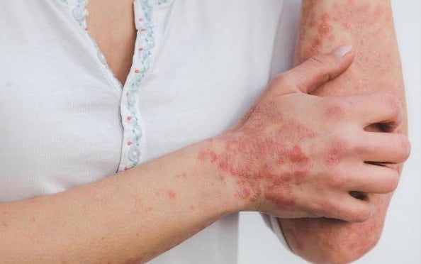 Lạm dụng thuốc chống viêm, ức chế miễn dịch điều trị vẩy nến tiềm ẩn nhiều tác dụng phụ