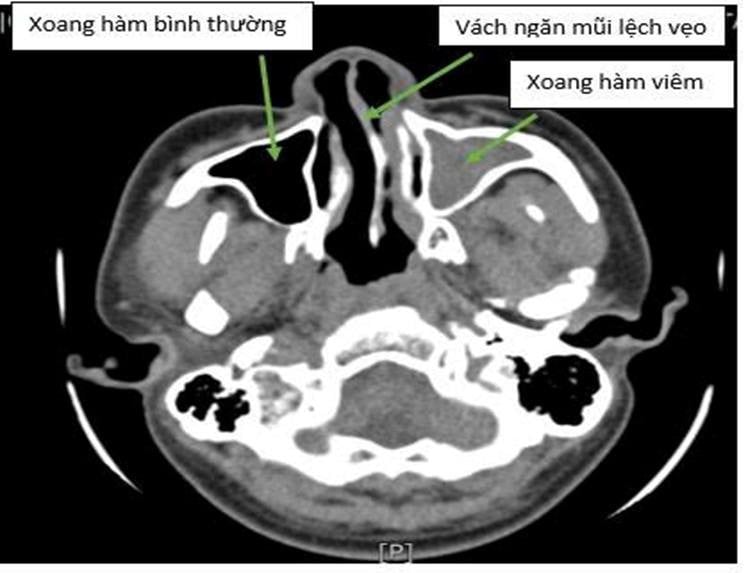 Hình ảnh vẹo vách ngăn mũi trên nội soi - Ảnh BVCC