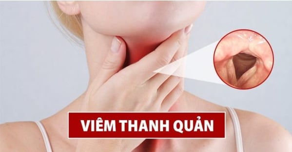 Viêm thanh quản gây khàn tiếng, mất tiếng