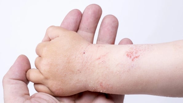 Viêm da đặc trưng bởi các nốt mẩn đỏ lấm tấm trên da.
