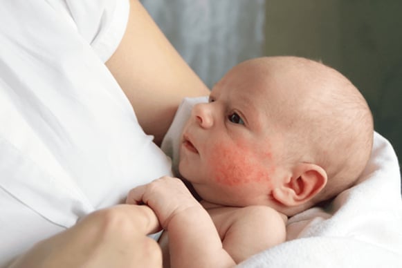 Trẻ bị viêm da cần được chăm sóc đúng cách tại nhà.