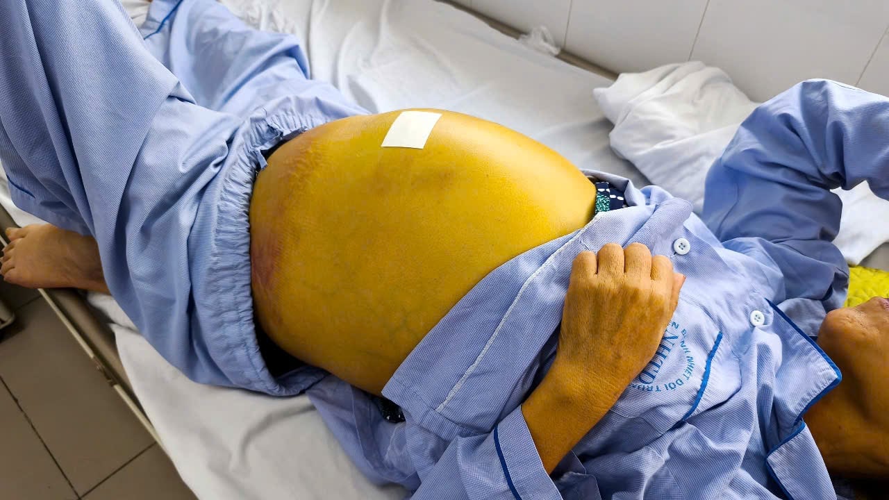 Làn da vàng như nghệ của bệnh nhân xơ gan, viêm gan B nặng tại Bệnh viện Bệnh Nhiệt đới Trung ương (Ảnh: BVCC)