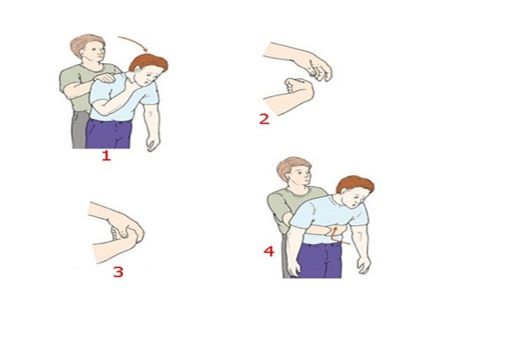 Nghiệm pháp Heimlich cần được sử dụng khi tắc nghẽn đường thở nặng và đe dọa tính mạng.
