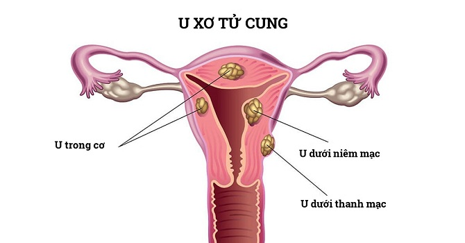 Phân loại u xơ tử cung theo vị trí