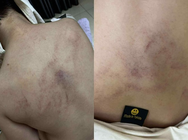 Phụ huynh cháu T.K.L tố giáo viên bạo hành trẻ - Ảnh: Báo An ninh thủ đô