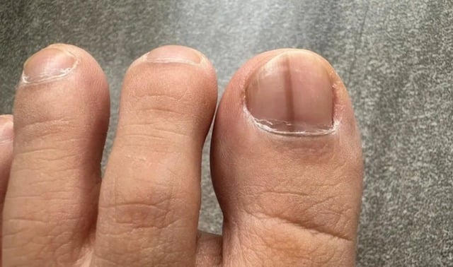 Hình ảnh vệt đen dưới móng cảnh báo u hắc tố – dấu hiệu thường bị nhầm với chấn thương. Ảnh minh họa