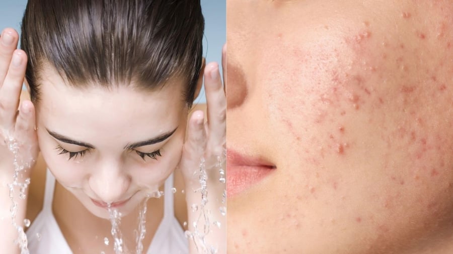 Rửa mặt nhiều lần trong ngày có thể gây tăng tiết dầu nhờn, dẫn đến mụn.