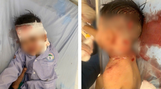  Cháu bé 3 tuổi bị chó cắn với nhiều vết thương nghiêm trọng - Ảnh: Báo Lao Động