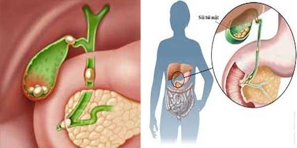 Các cơn đau hạ sườn phải là triệu chứng phổ biến của bệnh sỏi mật, gặp cả ở sỏi túi mật và sỏi đường mật.