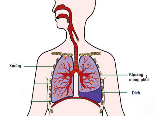  Tràn dịch màng phổi là biến chứng nguy hiểm của bệnh lao.