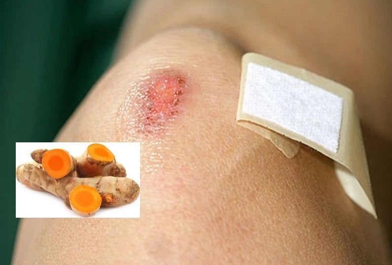  Chỉ nên bôi nghệ khi vết thương đã khô và lên da non (thường từ 2–4 ngày sau chấn thương nhẹ). Ảnh minh họa