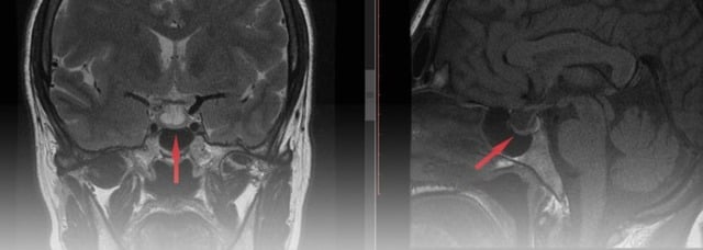  Hình ảnh MRI u tuyến yên – nguyên nhân hàng đầu gây suy tuyến yên hiện nay.