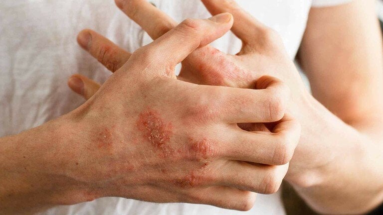  Thực phẩm là một trong những yếu tố phổ biến gây kích ứng hoặc làm bùng phát viêm da cơ địa. Ảnh minh họa