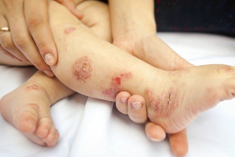  Trẻ bị viêm da cơ địa rất dễ kích ứng bởi bụi bẩn, nấm mốc, phấn hoa, lông vật nuôi. Ảnh minh họa