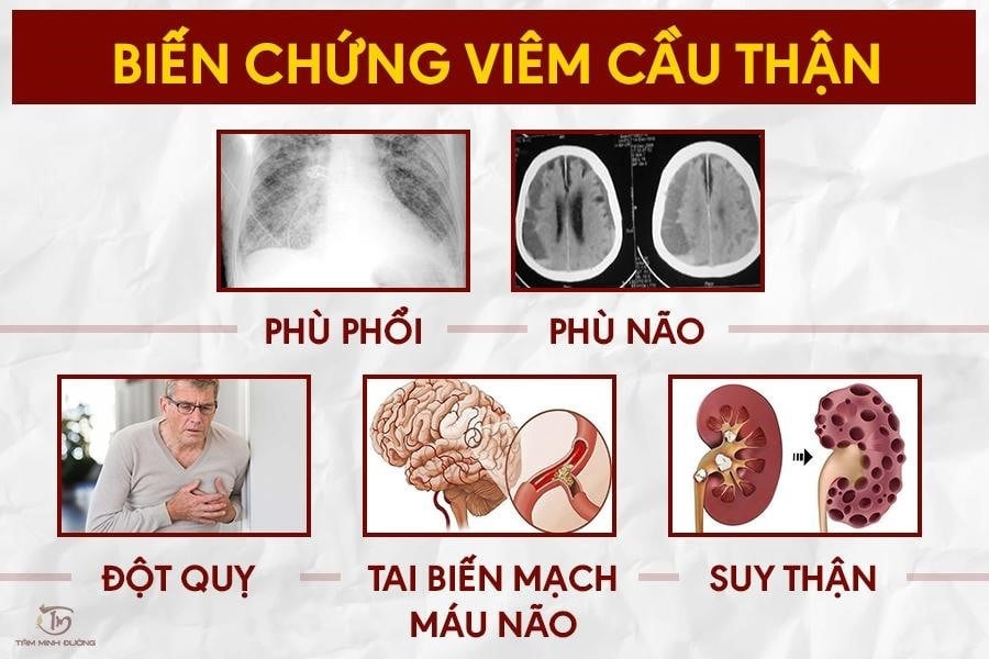  Biến chứng viêm cầu thận - Ảnh minh họa nguồn Internet