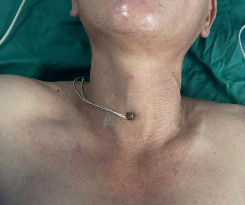  Người đàn ông bị dị vật đinh sắt đâm giữa cổ - Ảnh BVCC