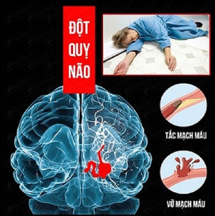  Thời gian là não nên bệnh nhân đột quỵ cần đến viện càng nhanh càng tốt - Ảnh minh họa nguồn Internet
