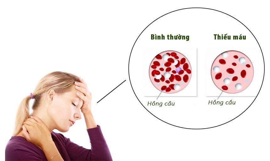  Biểu hiện của ung thư máu - Ảnh BSCC