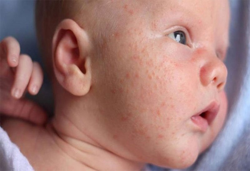  Rôm sảy khiến da bé trở nên đỏ và sần sùi