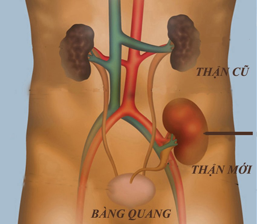  Ghép thận giúp thay thế chức năng thận ở người suy thận độ 5