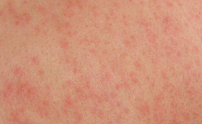  Ngứa da có xu hướng cải thiện khi sử dụng bộ 3 thành phần cao gan, cao nhàu và L-Carntine fumarate