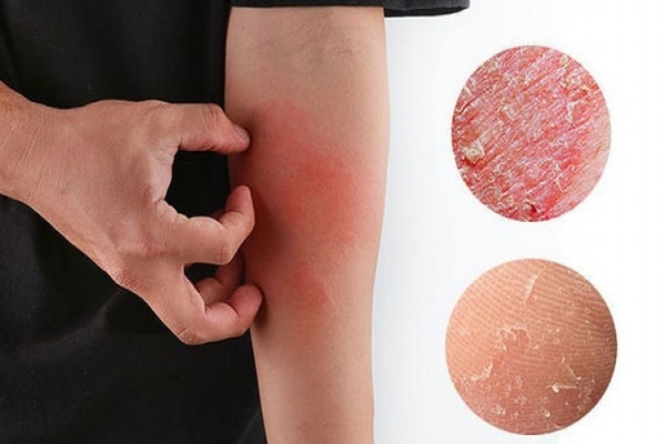 Ngứa da vào ban đêm thường do rối loạn miễn dịch và suy giảm chức năng gan thận