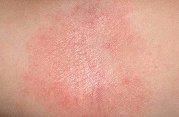  Ngứa da về đêm gây ảnh hưởng nghiêm trọng đến sức khỏe người bệnh