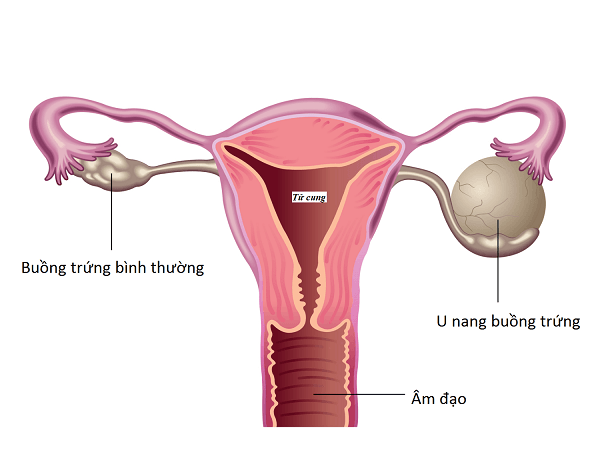  U nang buồng trứng kích thước lớn cần được phẫu thuật càng sớm càng tốt